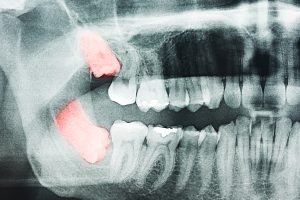 x-ray of wisdom teeth coming in sideways